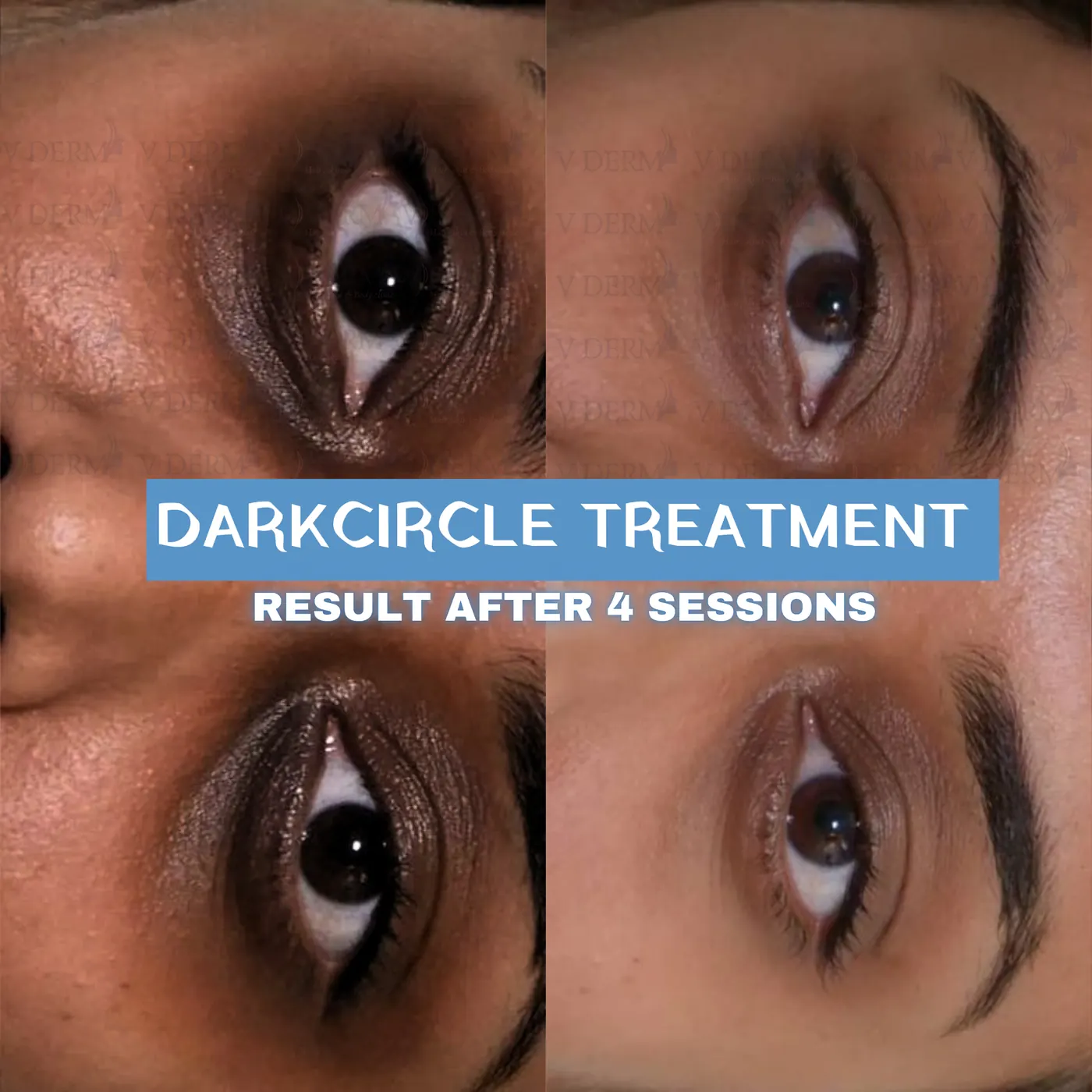 Clinic-supplied under-eye treatment comparison