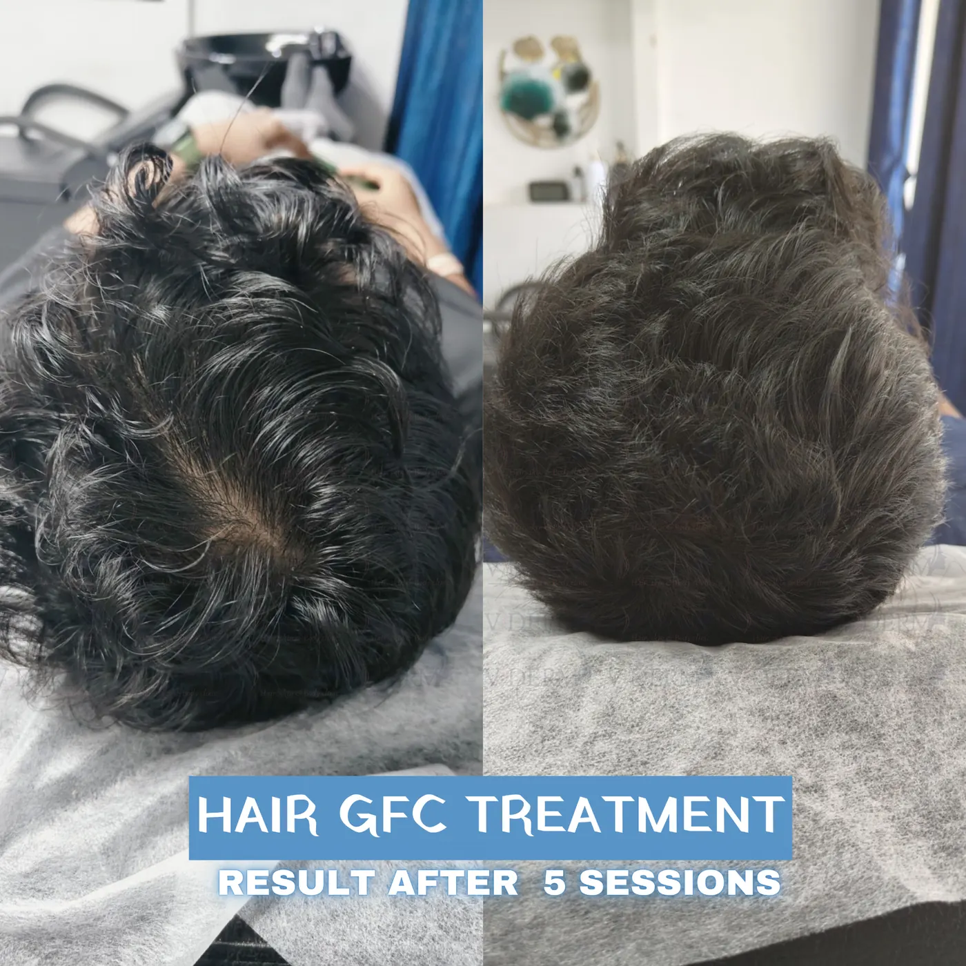 Clinic-supplied hair GFC crown comparison