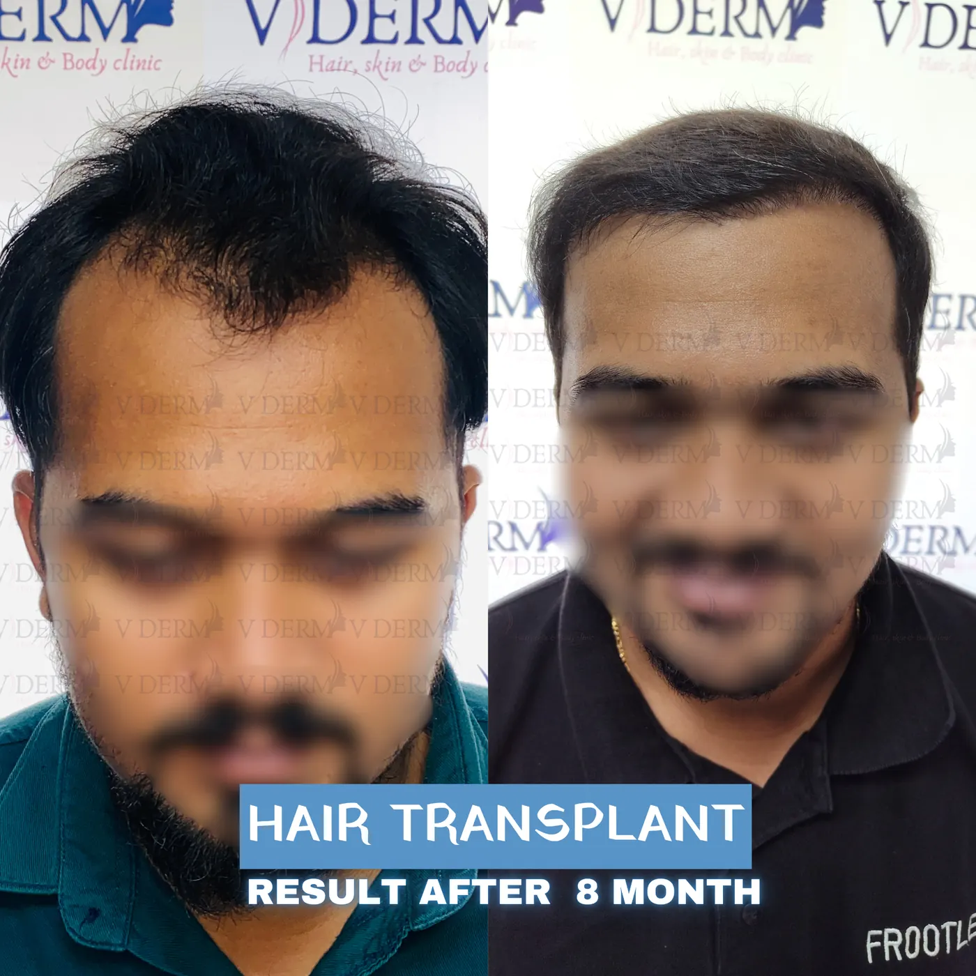 Clinic-supplied hair transplant comparison