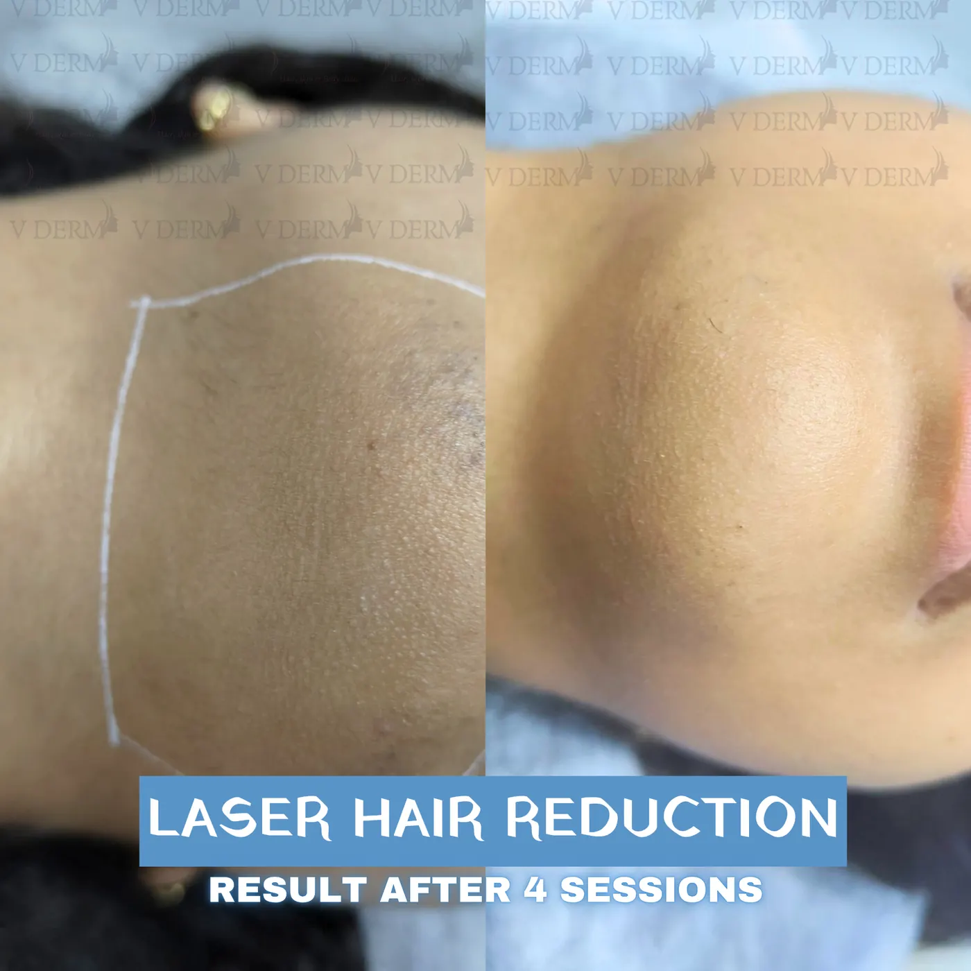 Clinic-supplied laser hair reduction comparison