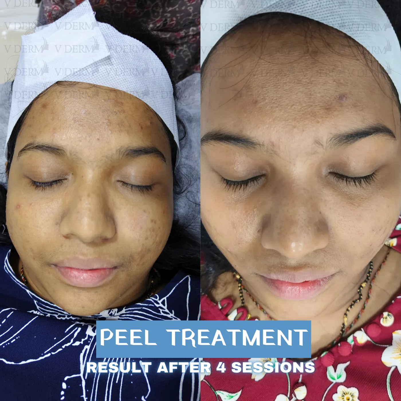 Clinic-supplied peel treatment comparison