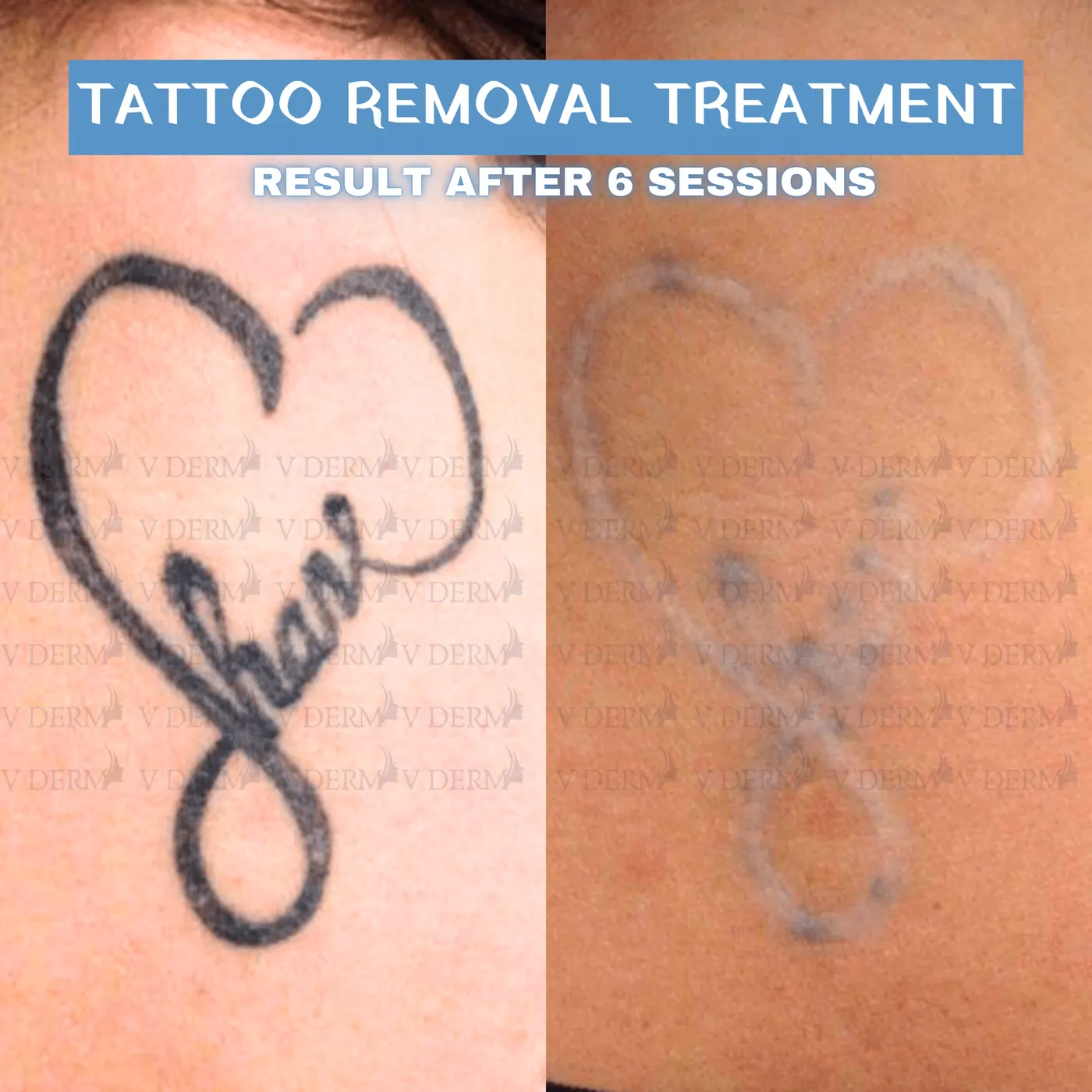 Clinic-supplied tattoo removal comparison