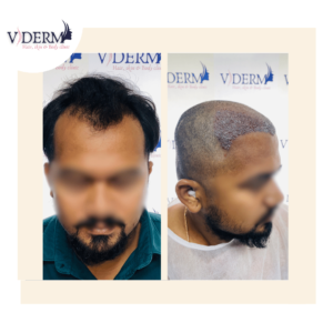 hairtransplant before after